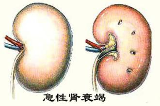 急性腎衰竭